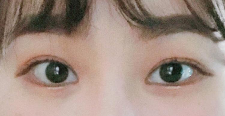 눈재수술 후기