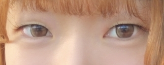 쌍꺼풀(절개) 후기