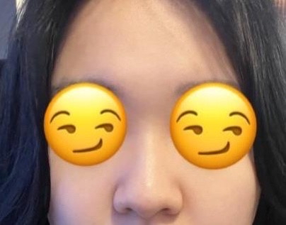 매부리코성형 후기