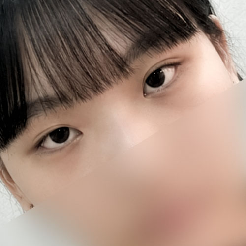 눈재수술 후기