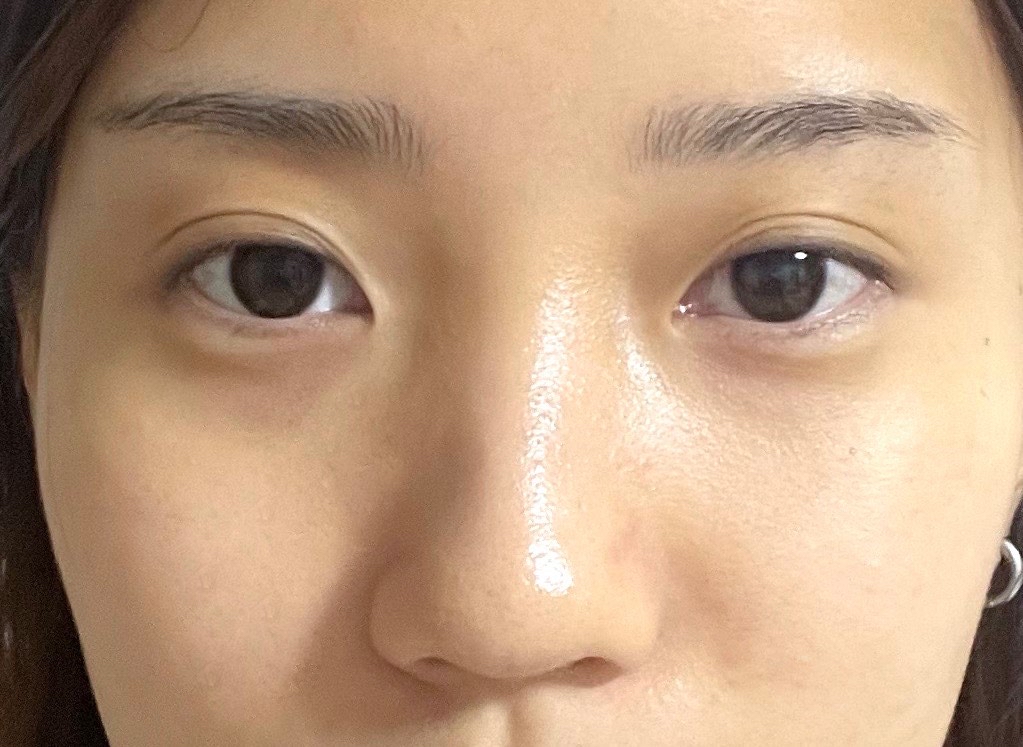 코끝(자가연골) 후기