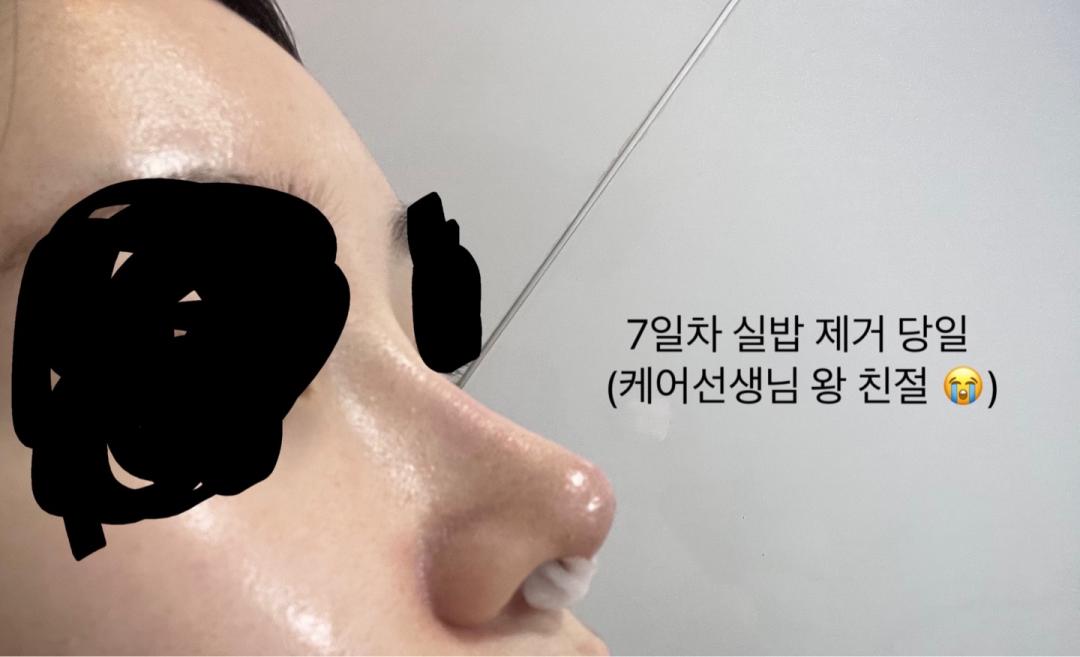 코재수술 후기