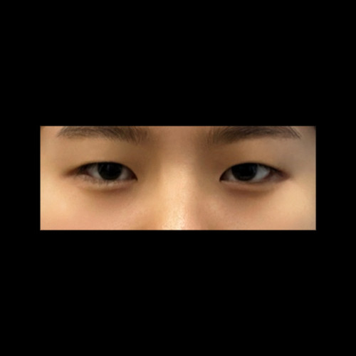 쌍꺼풀(절개) 후기