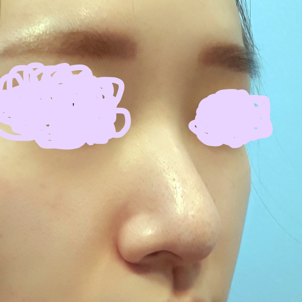 코재수술 후기