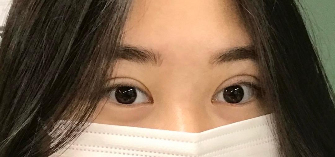 눈재수술 후기