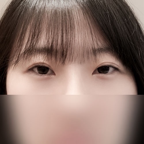 밑트임 후기