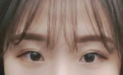 눈재수술 후기