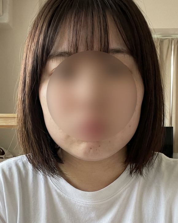 온다리프팅 후기