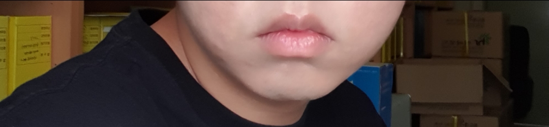 입꼬리성형 후기