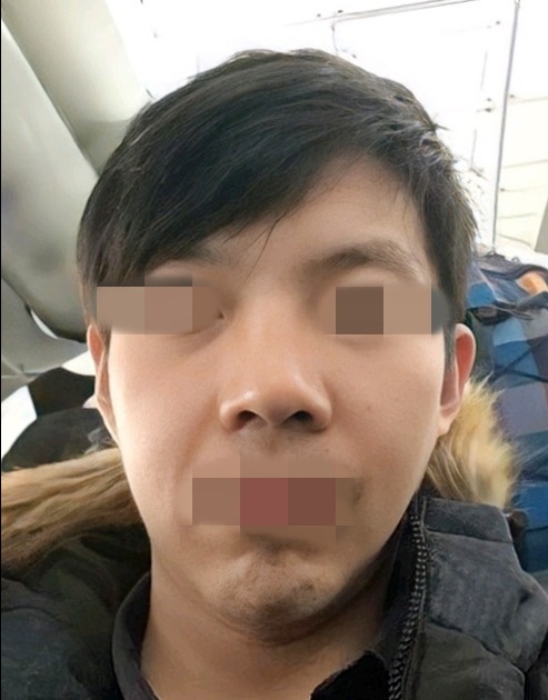 콧볼축소 후기