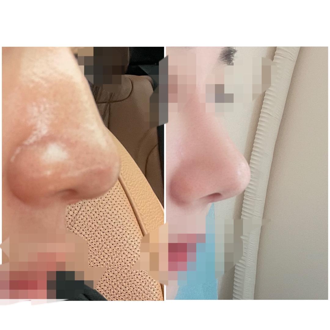 콧볼축소 후기