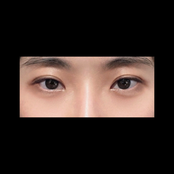 눈재수술 후기