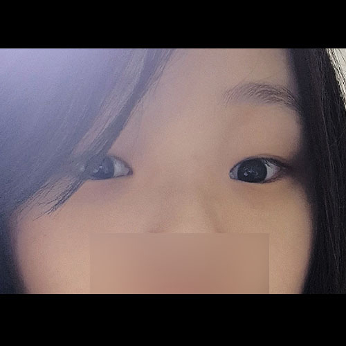 쌍꺼풀(자연유착) 후기