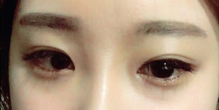 쌍꺼풀(매몰) 후기