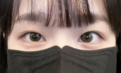쌍꺼풀(자연유착) 후기