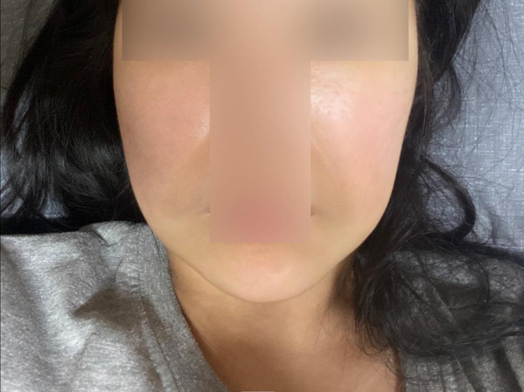 실리프팅 후기