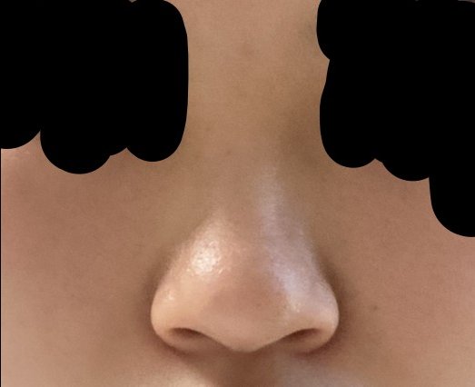 코끝(기증연골) 후기