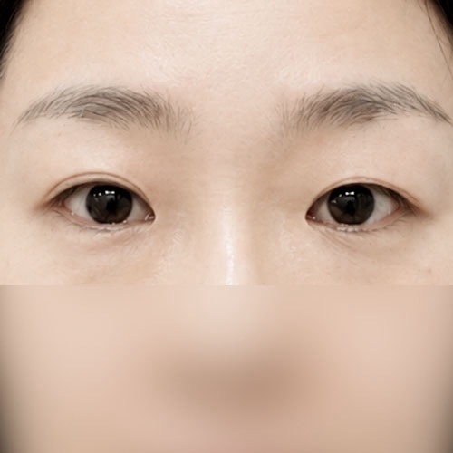 쌍꺼풀(자연유착) 후기