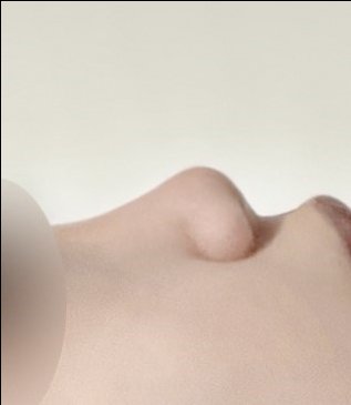 콧대(보형물) 후기