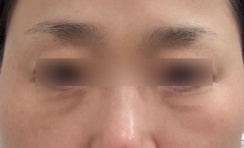 눈밑지방재배치 후기