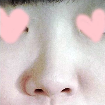 코끝(기증연골) 후기