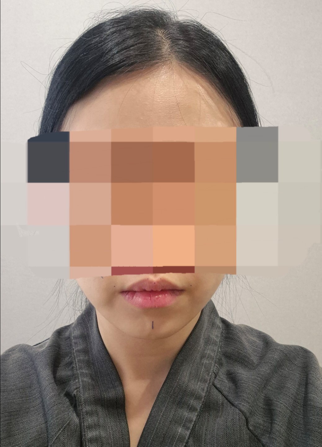 입꼬리성형 후기
