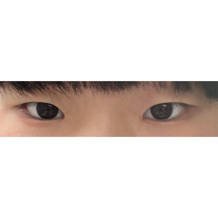 쌍꺼풀(절개) 후기