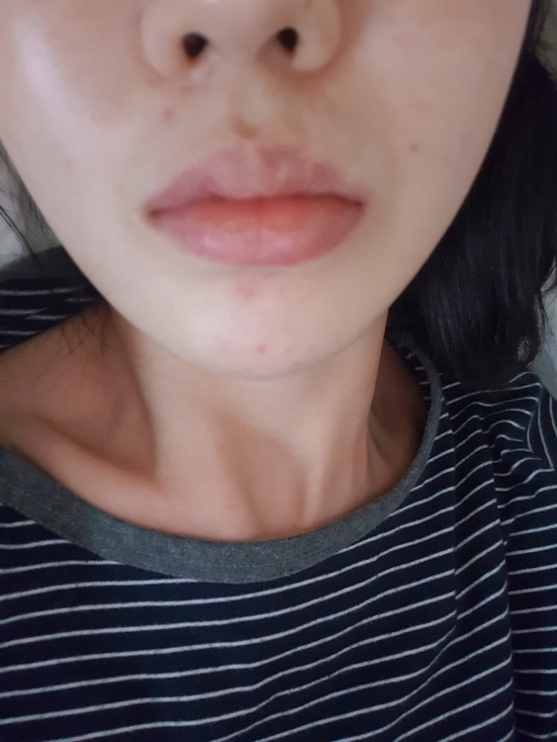 눈썹거상술(내시경) 후기