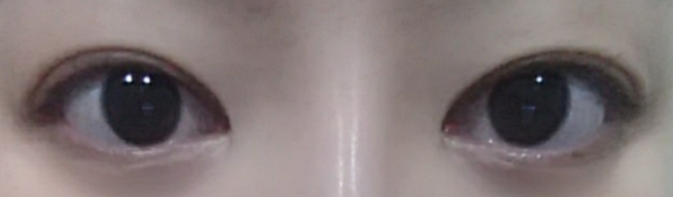 눈재수술 후기
