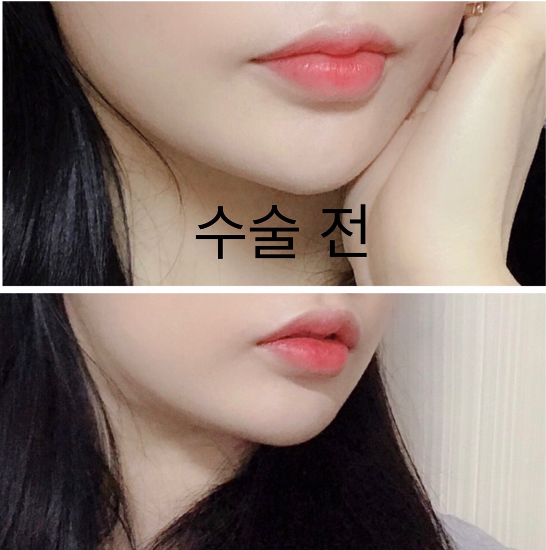 입꼬리성형 후기