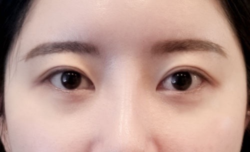 밑트임 후기
