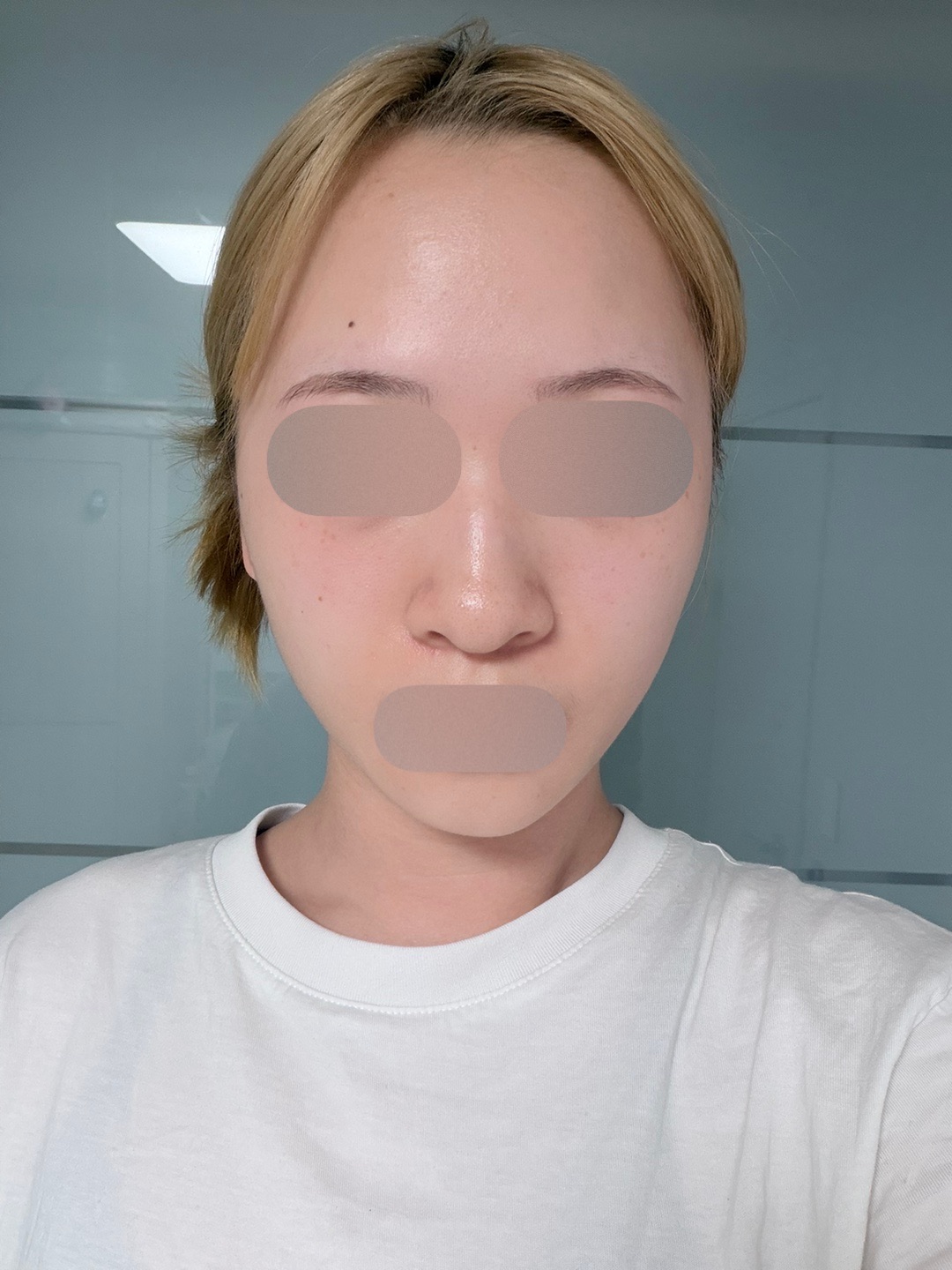 매부리코성형 후기