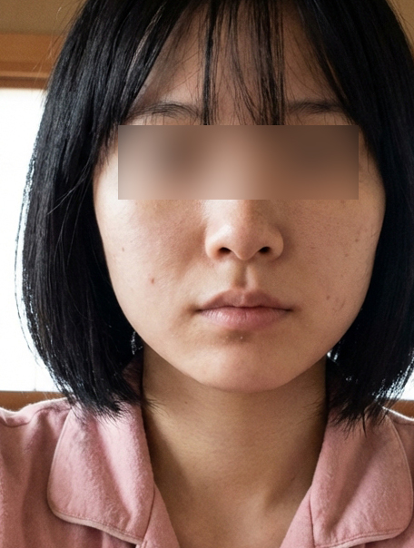 온다리프팅 후기