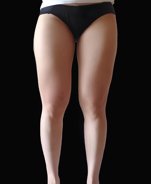 허벅지지방흡입 후기