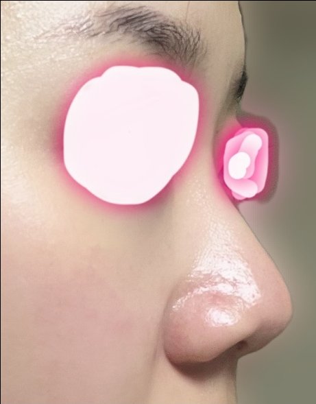 콧대(보형물) 후기