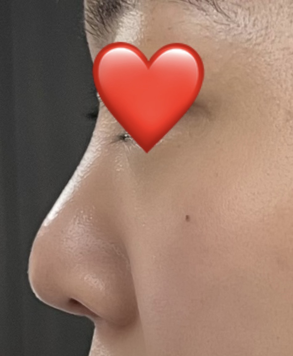코재수술 후기