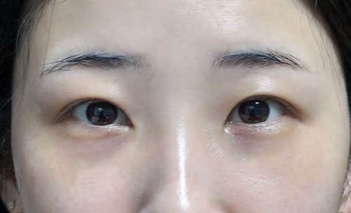 밑트임 후기