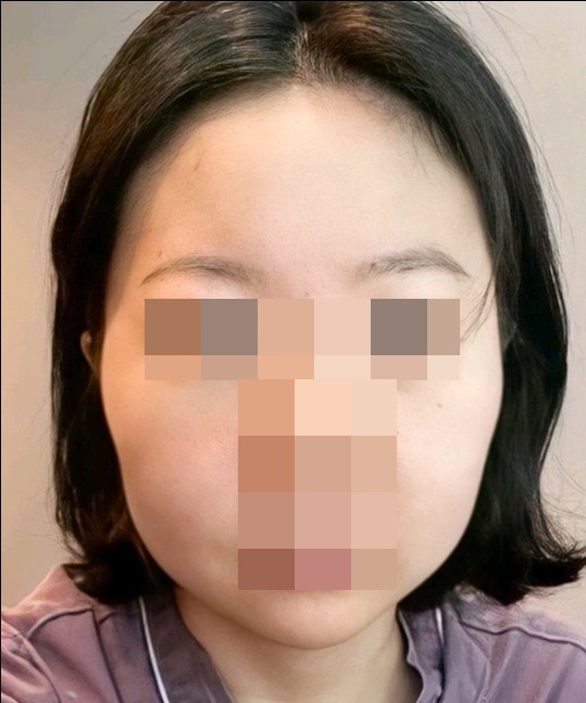 광대축소(앞광대) 후기