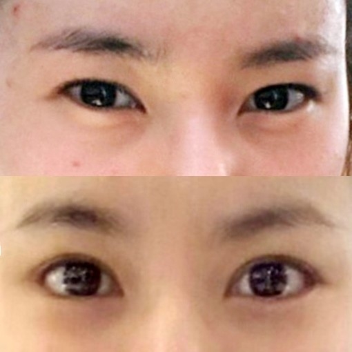 눈재수술 후기