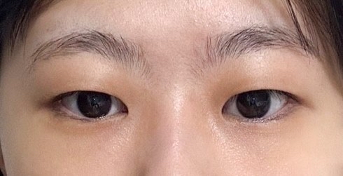 쌍꺼풀(절개) 후기