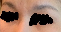눈밑지방재배치 후기