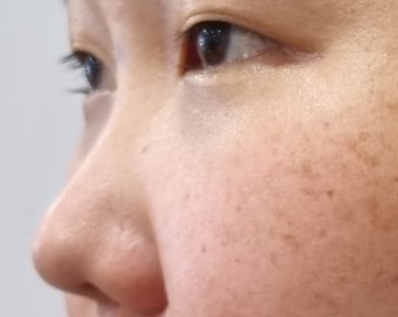 눈재수술 후기