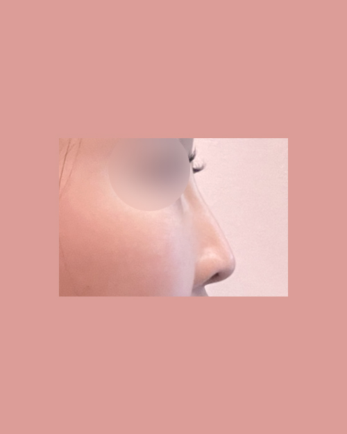 코재수술 후기