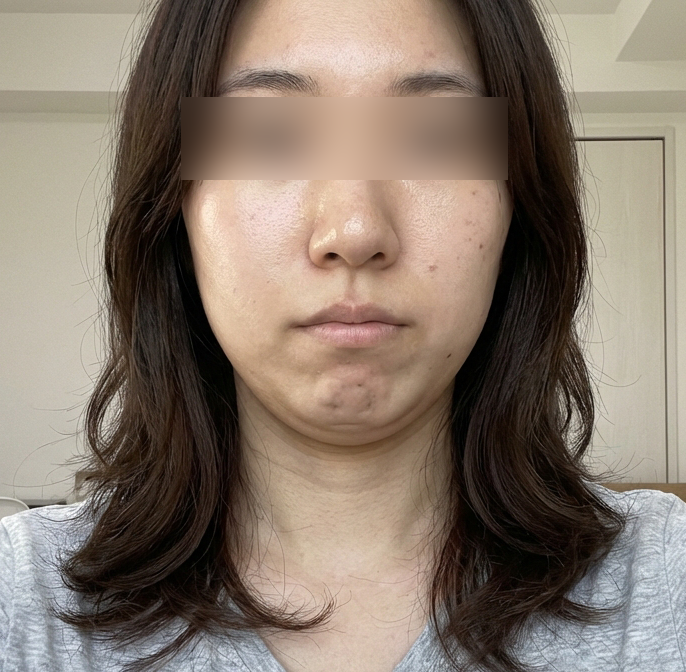 온다리프팅 후기