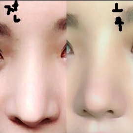 코재수술 후기