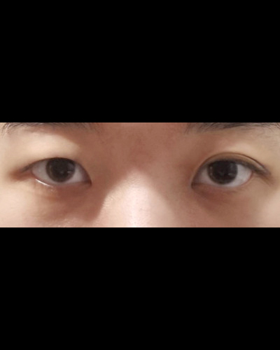 쌍꺼풀(절개) 후기
