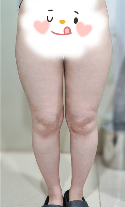 허벅지지방흡입 후기