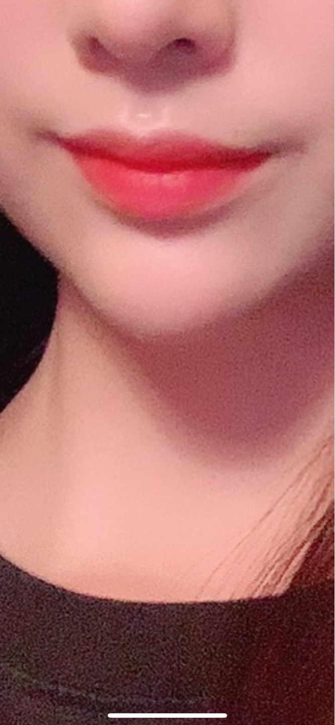 입꼬리성형 후기