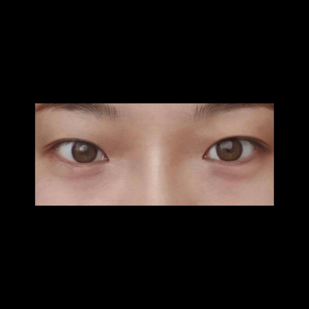 밑트임 후기