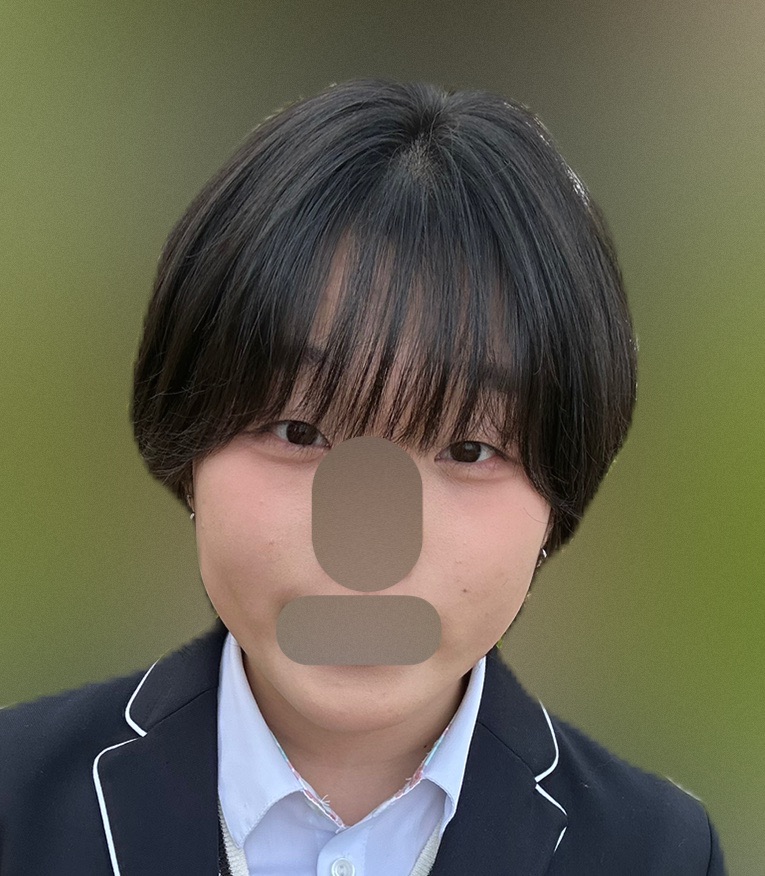 쌍꺼풀(절개) 후기